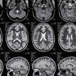 Traumatic Brain Injury Settlement Amounts in Florida