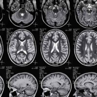 Traumatic Brain Injury Settlement Amounts in Florida